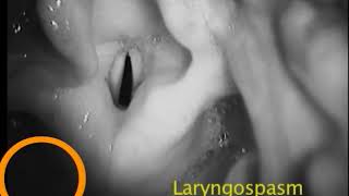 1-17. Laryngospasm