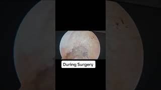 ACL + PCL SURGERY (RECONSTRUCTION) MULTI-LIGAMENTOUS KNEE INJURY #ligament #acltear #reconstruction