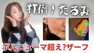 【たるみ治療】高周波治療💡❤️‍🩹色々受けて今回はnew施術ザーフのレビュー動画です🌟【ザーフ】