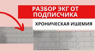 Разбор ЭКГ от подписчика.  Преходящая блокада левой ножки пучка Гиса?