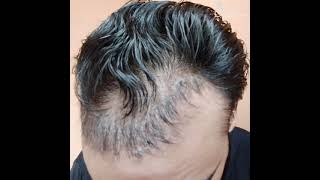 Hair Transplant Before After Results Till 9 Months | Hair Loss Results | Hair Fall Solution