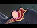 Treating snoring in sleep medical animation