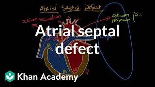 Atrial septal defect | Circulatory System and Disease | NCLEX-RN | Khan Academy
