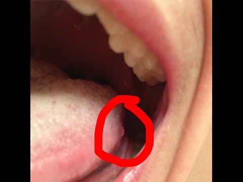 2 Main Reasons of Bumps on Back of Tongue 2 Main Reasons of Bumps on Back of Tongue