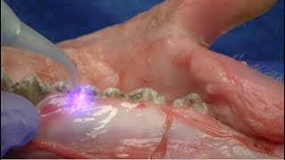 NV® PRO3 Microlaser Procedures - Gingivectomy - DenMat Dental Education