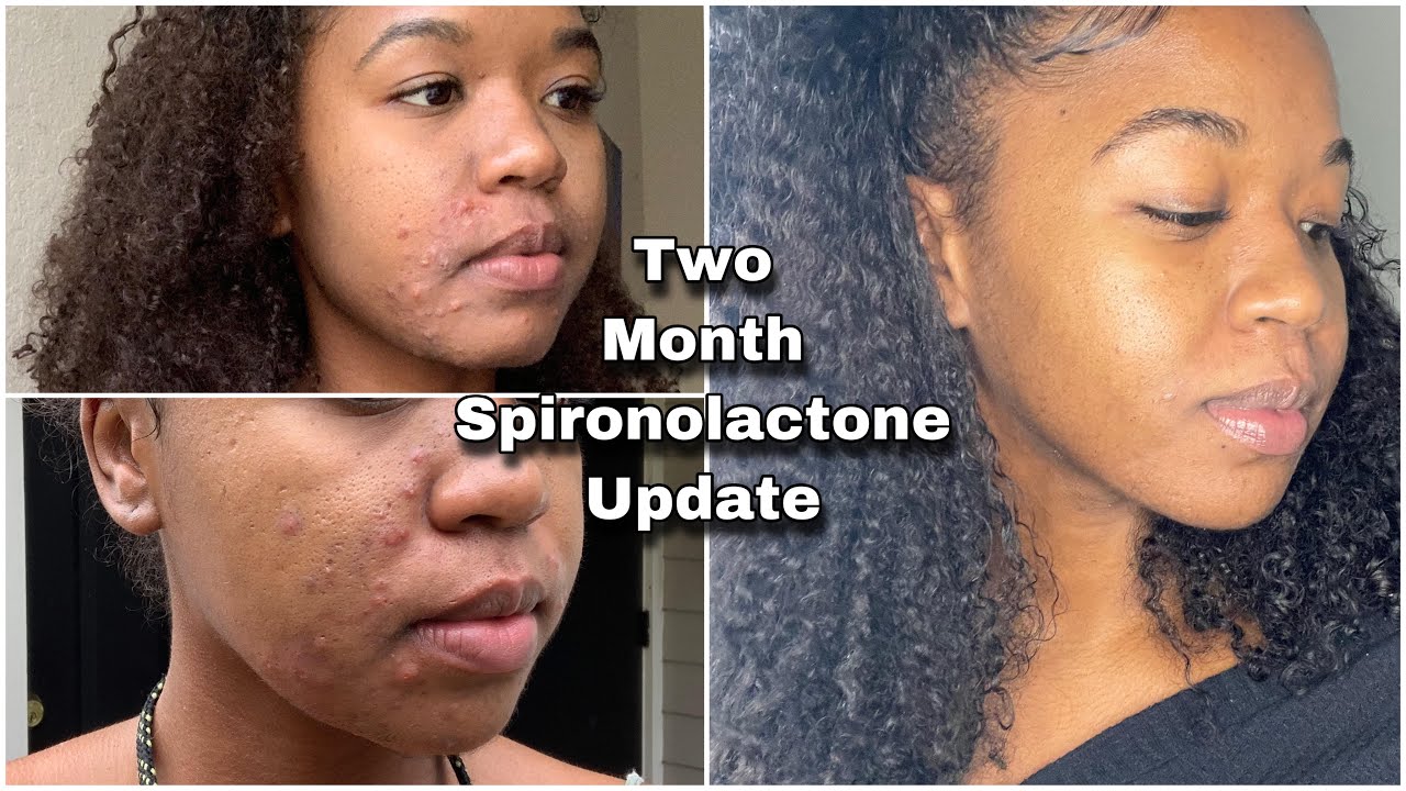 Hormonal Acne Journey | Spironolactone Month 2 Update - YouTube