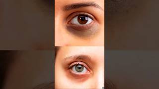 Remove your dark circles | For any queries call Dr. Sonia 9891797084 #skincare #wellness