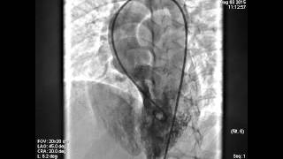 1 Perimembranous VSD Device Closure LV Angiogram
