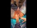 labiaplasty vaginal tightening procedure part 3 david ghozland m.d.