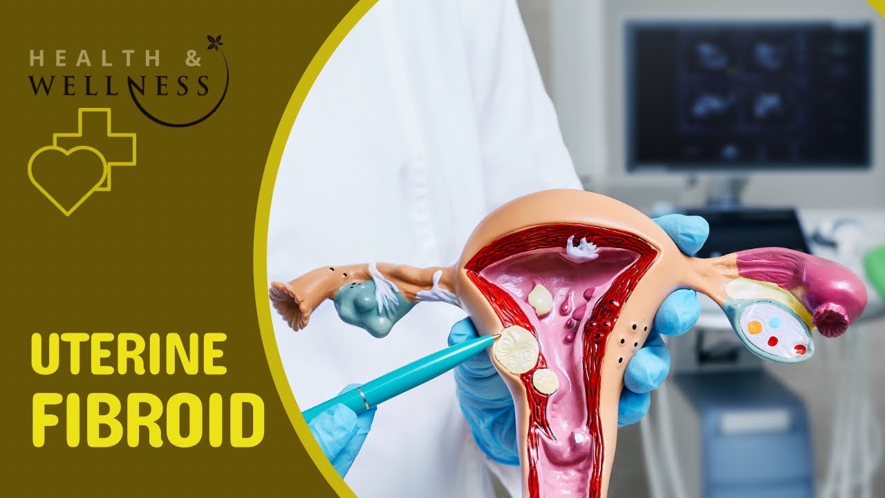 Fibroid Facts: Growth, Symptoms, And Solutions - YouTube