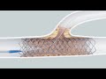 Glider PTCA Balloon Catheter Video