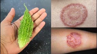 Natural Home Remedies For RINGWORM  -ഇതൊന്നു തടവിയാല്‍ മതി വട്ടചോറിയും പുഴുക്കാടിയും മാറിക്കിട്ടും