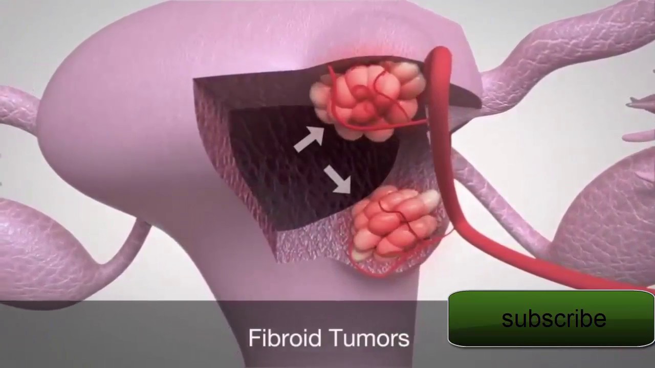 How Fibroids Are Treated - Fibroid Removal Surgery - YouTube