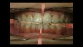 Hamilton Braces - Some cool examples of orthodontic cases