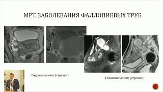 МРТ таза в диагностике бесплодия - Синицын В.Е.