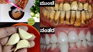 ಮನೆಯಲ್ಲೇ ನಿಮ್ಮ ಹಲ್ಲುಗಳನ್ನು ಕೇವಲ 3 ನಿಮಿಷಗಳಲ್ಲಿ ಬಿಳಿಯಾಗಿಸಿ | How to Naturally whiten your yellow teeth