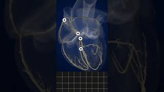 How to Easily Remember Heart Sounds in 60 Seconds