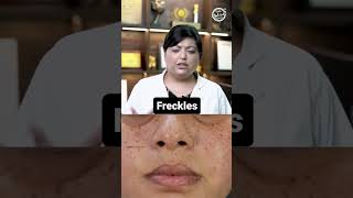 How to get rid of Freckles? #freckles #skincare #shorts #DMC #drniveditadadu