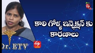 కాలి గోళ్ళ ఇన్ఫెక్షన్ కు కారణాలు | డాక్టర్ ఈటీవీ  | 18th అక్టోబర్ 2021| ఈటీవీ  లైఫ్