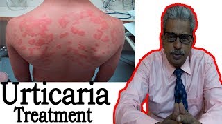 Urticaria - Discussion and Remedy in Homeopathy by Dr P.S. Tiwari
