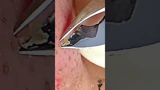 Skincare | Blackheads Removal #019 #blackheads #skincare