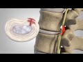 Herniated Discs Final Video