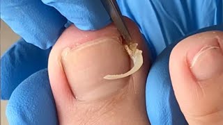 Pedicure Tutorial: Ignore ingrown nails, causing redness and pain, trim them in time【Xue Yidao】