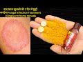 दाद खाज खुजली की 2 दिन में छुट्टी करदेगा Fungal Infection Treatment/ Ringworm home remedy