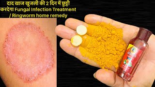 दाद खाज खुजली की 2 दिन में छुट्टी करदेगा Fungal Infection Treatment/ Ringworm home remedy