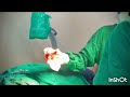 excision of hypertrophied axillary tail of spence accessory breast by dr sumit k bakle m.s