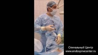 Удаление грыжи позвоночника. Percutaneous endoscopic discectomy.