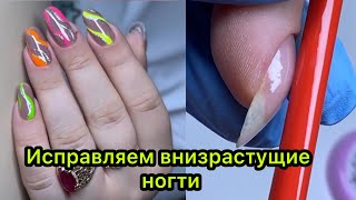 Исправляем внизрастущие ногти