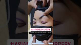 Preparation for Asian Double Fold Eyelid surgery | Asian blepharoplasty| eyelid surgery #shorts