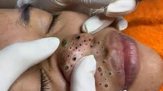 Treatment Of Blackheads And Hidden Acne  #017