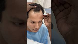 Bangladesh Boy came to Bangalore for Hair Transplant