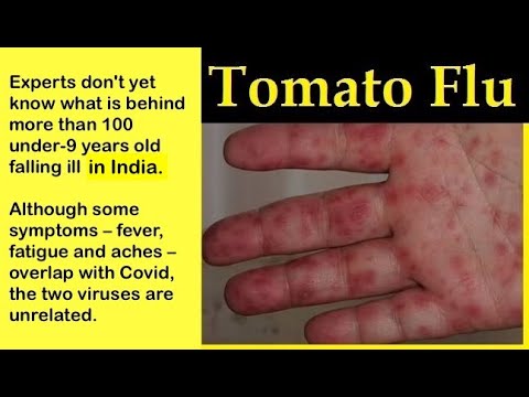 New Tomato Flu Virus (Tomato Fever) In India -- What We Know So Far ...