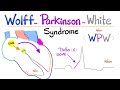 Heart Arrhythmia - Wolff-Parkinson White (WPW) Syndrome - AVRT - Supraventricular Tachycardia - ECG