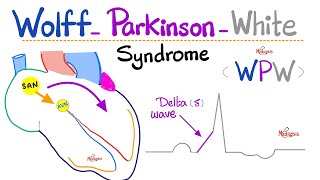 Heart Arrhythmia - Wolff-Parkinson White (WPW) Syndrome - AVRT - Supraventricular Tachycardia - ECG