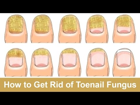 How to Get Rid of Toenail Fungus Fast and Naturally How to Get Rid of Toenail Fungus Fast and Naturally