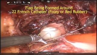 Robotic Boari Flap