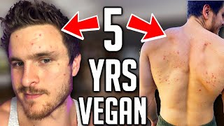 Veganism Does NOT Clear Acne (IT MAKES IT WORSE!)