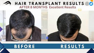 Hair Transplant In Salem | Best Results Center Cost \u0026 Doctor Of Hair Transplant In Salem