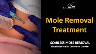 Mole Removal Treatment | Scarless Mole Removal | Nitai Medical \u0026 Cosmetic Centre