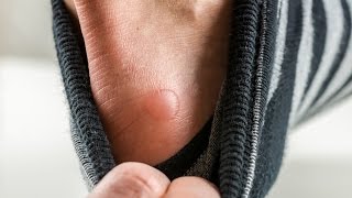 The Basics Should You Pop A Blister Webmd