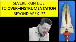 How to prevent pain and tenderness due to over-instrumentation ?