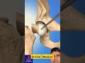 #hip bone riplasment surgery #ortho#ortho surgen #medical#medicine#drviralmedical