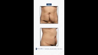 Abdominoplasty \u0026 Lipo on Hip Rolls: Transformation by Dr. Blanchard