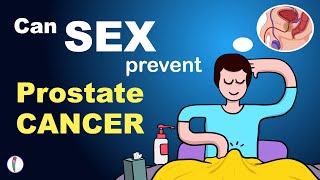 Can Frequent SEX Prevent Prostate CANCER | Ways to prevent prostate Cancer