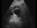 Abdominal Aortic Aneurysm (AAA) Ultrasound: 10/2020