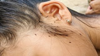 How to pick out a lot of big head lice - Removing hundred head lice from hair